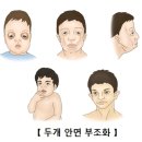 두개 안면 부조화(Craniofacial dysharmony) 성형미용, 소아청소년질환이란?] 이미지