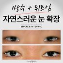 쌍수 뒤트임 결막부종 끝나고 눈 크기 변화는? 이미지