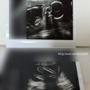 영화로운 | 마곡 산부인과 당일 방문 후기 | 영화로운 여성의원 초음파 비용 13,500원 (21주 실진료)
