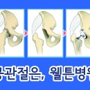 ﻿﻿﻿고관절통증, 고관절질환 ,대퇴골두무혈성괴사, 고관절수술, 인공관절수술, 인공관절지환술 이미지