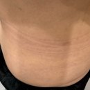 티스테이션강남점 | 옆구리 뒷구리 없애기 도전! 신사 지방분해주사 제로클리닉 후기