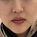 300 | [공지] 강남역 울쎄라 리프팅 잘하는 곳 커스텀 300샷 후기 및 비용