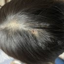 예닮의원 | 피부섬유종(두피섬유종) 제거 후기, 실비 (feat. 제주도 예닮빛의원)