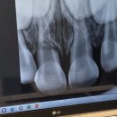 더끌림소아치과의원 | 우리집 어린이 앞니 부러짐... 소아 치과에서 웃음 가스 치료받음