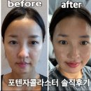 리젠의원 | 용인스킨부스터 포텐자콜라스터 시술후기 (EGF리젠셀 재생크림으로 관리)