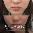 Point-붉은 날 | 부산 써마지 피부과 유명한 곳 효과 내돈내산 후기