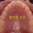 서경의원 | 방배 교정전문 시크릿치과]입돌출 청년의 교정치료 후기; "성형수술했냐는 소리 들을 때마다 기분이...