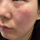 신논현역피부과 리쥬란힐러 4cc 더마샤인 내돈내산 후기 (엠보, 통증, 가격 포함)