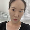 더블유스토어 이도약국 | [나의 피부염 이야기] 주사피부염 · 스테로이드 부작용 · 스테로이드 리바운드 · 탈스테로이드