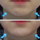 맑고고운라벨라의원 | [원장칼럼] 코필러, 입술필러, 턱끝필러, 시술 순서가 중요합니다.