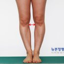 오다리, 휜다리교정 - 수술직후 / 4개월후 / 1년후 . . 이미지