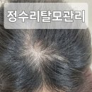 수원 정수리 탈모 개선 두피관리, 두피 문신까지 전문적으로 진행하는 SMP Studio
