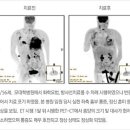 동맥내 항암치료란 무엇인가? 이미지