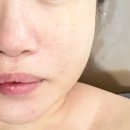 중화동 피부관리 엔에이에스테틱 여드름피부 더마리셀관리 후기