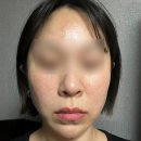 더유스의원 | 모공시술 유스 자가진피재생술(트리필프로 + 엘라비에 리투오) 받고 온 후기