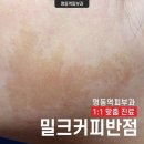 단계반점 이미지