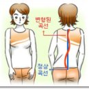 [디스크｜허리디스크] - 한쪽으로 휜 허리 ‘척추 측만증’ 이미지