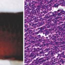 호산육종 이미지