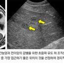 초음파 유도 하 조직검사[ultrasound guided biopsy] 이미지