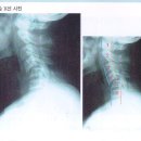 척수손상- X-ray와 MRI 비교 이미지