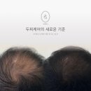 백원장 | 반포 잠원역 두피문신 | 아이디헤어 메이플자이점 백원장의 소레아 두피문신