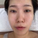 마곡여드름관리 희아로움 여드름관리 솔직후기