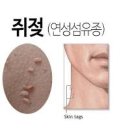 쥐젖 생기는 이유 목 겨드랑이 눈 밑 레이저 이미지