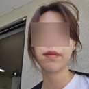 줌스토리 | 팔자를 피자 스토리 피부과 팔자 필러 내돈내산 후기