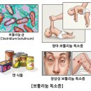 보툴리눔독소증[Botulism]감염성 질환 이미지