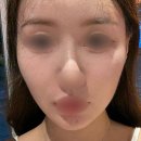 V(브이) | 가나브이(GANA-V) 콜라겐 필러 후기, 실리프팅을 함께 활용한 환자?