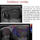 Epididymo-orchitis 이미지