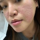 건성 | 부산 리쥬란 후기 건성피부 덕천 피부과 피부결 관리 솔직리뷰