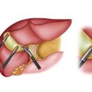 윗배 통증 원인 담석증 증상 및 치료 이미지