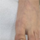 GS25진주장대점 | 진주 하대동 발톱무좀 관리 후 내성까지 제대로 벗어났어요~! 후네일&amp;베어진주장대점