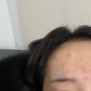 마이어스의원 | 26살에 성인 수두 걸린 후기 (1-7일차)