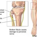 대구보조기 이미지