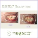 여의도이플러스치과의원 | 여의도 교정 연세라벤더치과 "7월 비발치 교정 후기"