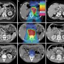 최첨단 방사선 암 치료 보고서! 중입자・양성자 치료로 암 정복을 향해 한 걸음 더 가까이 | KBS 240131 방송 이미지