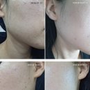 몸과맘한의원 | 천안 신부동 한의원 피부관리 한 달 후기 및 다이어트한약