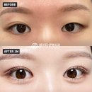 JT빌딩 | [눈성형전후 셀카] #자연유착 #앞트임 #윗트임 #셀카후기