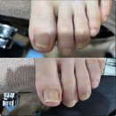 잠실내성발톱 확실하게 펴주는 닥터아이티엔 러블리