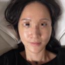 청담서클의원 | 청담서클의원 np리쥬란 후기(진짜 안아프긴함, 엠보도 없음)