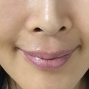 이미용 | [이미용 리뷰] 입술 라인 필러 후기 | 윗입술 라인 정리 + 아래입술 볼륨으로 입체감 업!