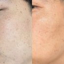 레이디피부관리실 | 천안피부관리/편평사마귀제거/쥐젖제거/잡티제거 [더레이디뷰티]