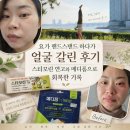 참약사 꿈약국 | 요가 핸드스탠드 하다가 얼굴 갈린 후기. 스티모린 연고와 메디폼 붙이고 거의 회복한 기록