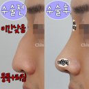센트럴티(T)성형외과의원 | 남자코수술, 부드러워 보인다고 주변에서 난리예요