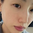 피부과 레이저 시술 후 재생크림 시카플러스트밤 B5+ 찐 후기