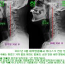 목디스크 수술을 권유 받았던 70대 환자의 치료예 이미지