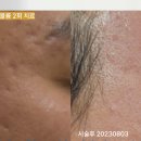 청담쥬넥스의원 | 반포피부과 여드름 흉터 치료 저 단 2회 치료만에 가능하다고 패인흉터 차오르는 쥬베룩볼륨 피코프락셀...