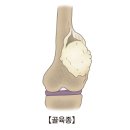 골육종 이미지